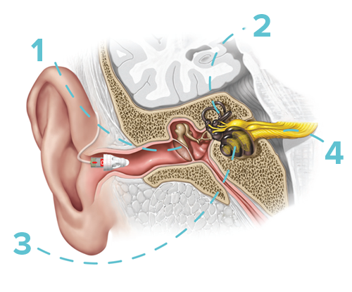 What is sensorineural hearing loss?